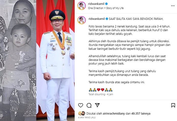 Kaki Ridwan Kamil bengkok parah semasa kecil, Selasa 18-Juli-2023