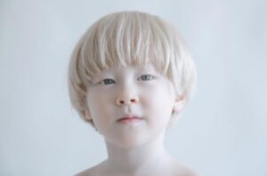 penyebab albino