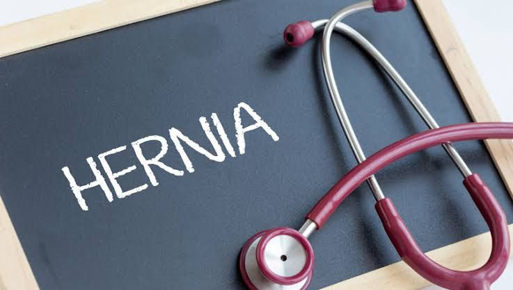 hernia