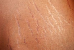 Penyebab Stretch mark