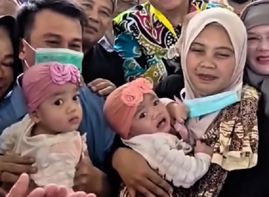 Operasi Kembar Siam RSHS - Instagram Dedi Mulyadi