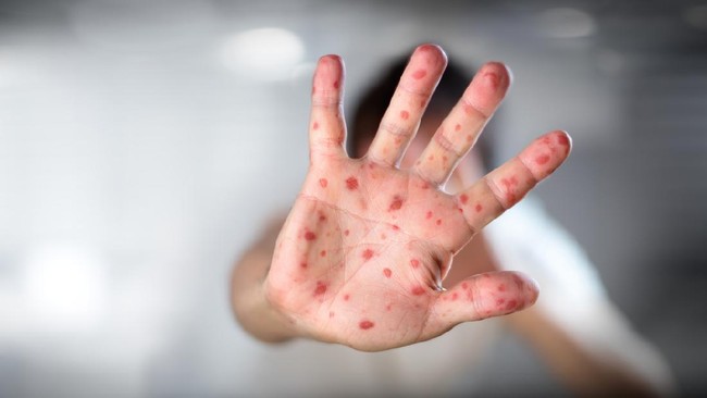 Kasus Suspek Campak Sumenep Jatim Capai 2.105 Anak